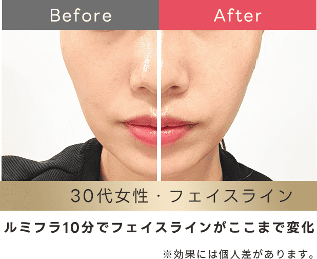 フェイスラインの変化
