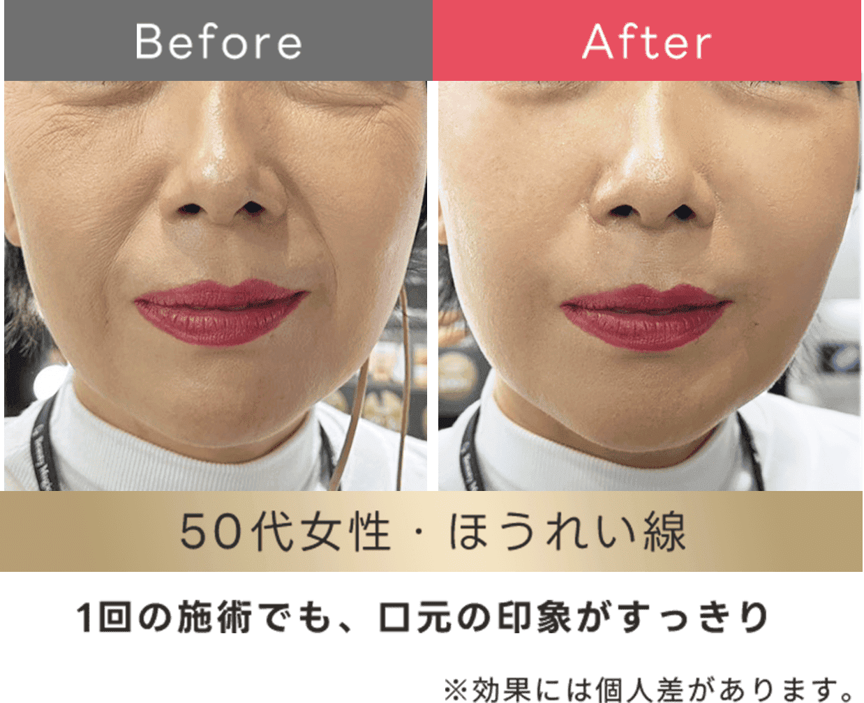 1回の施術でも口元の印象がスッキリ