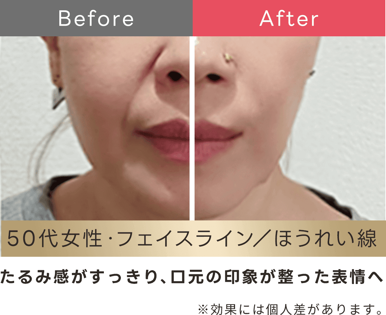 たるみ感がスッキリ、口元の印象が整った表情へ