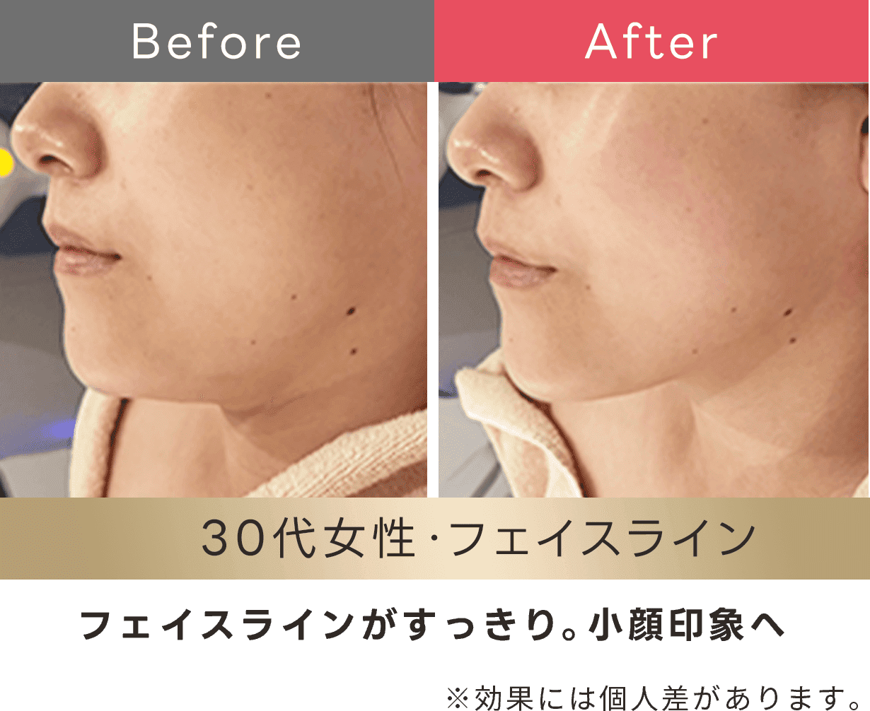 フェイスラインがスッキリ。小顔印象へ