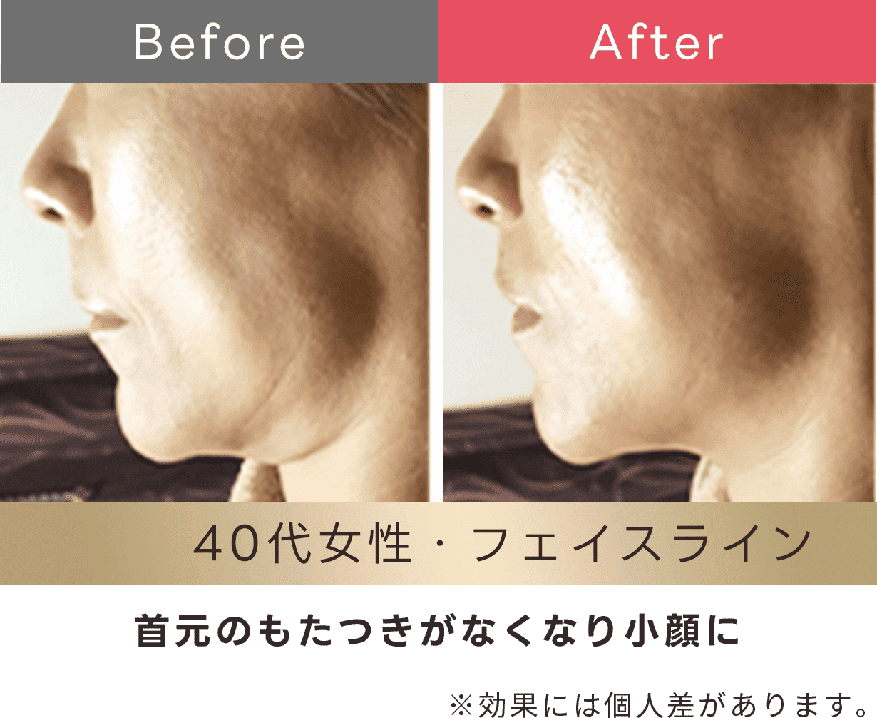 首元のもたつきがなくなり小顔に